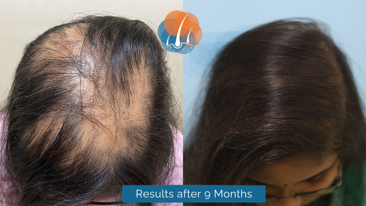 female hair transplant