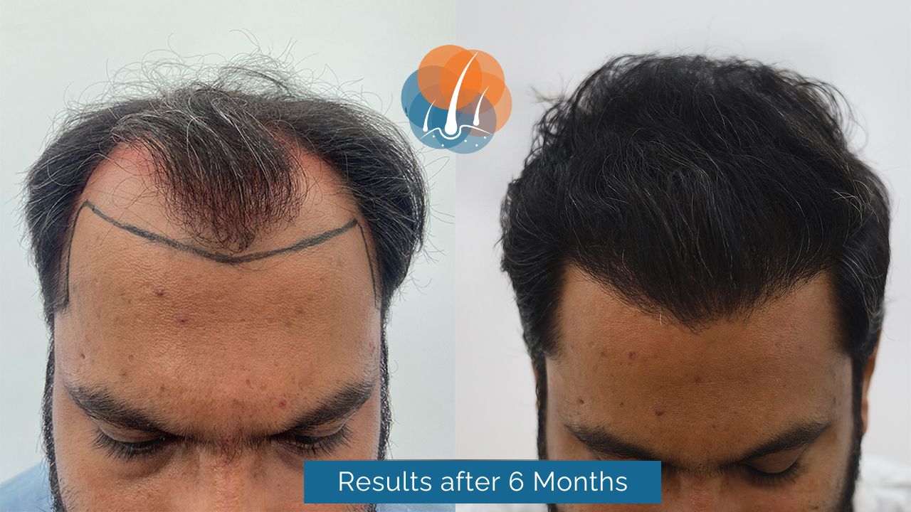 hair transplant bhubaneswar