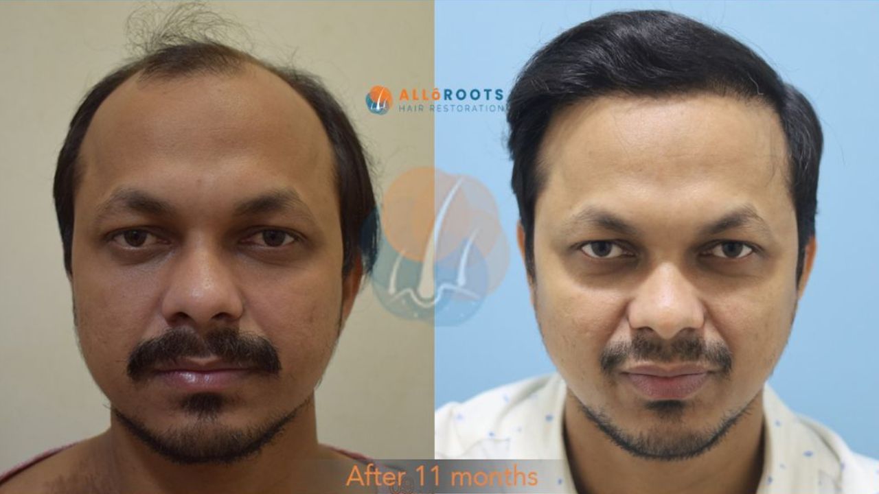 hair transplant bhubaneswar
