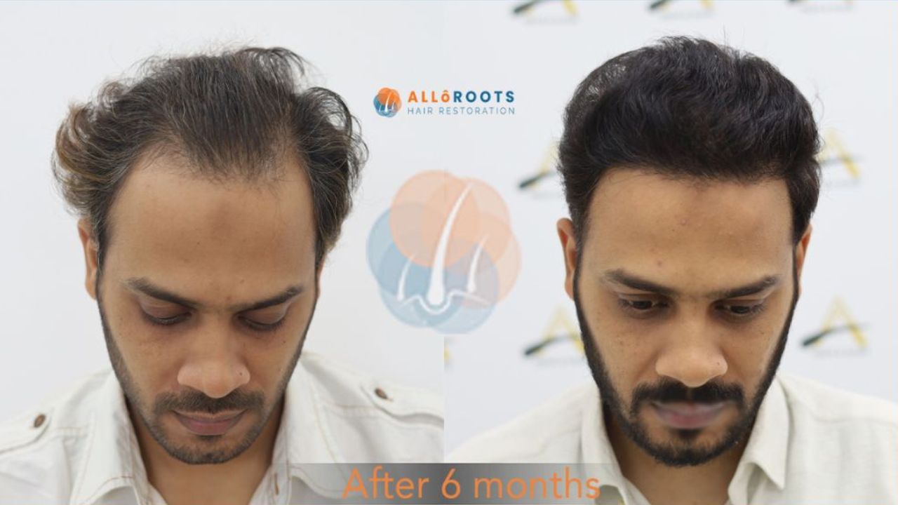 hair transplant bhubaneswar