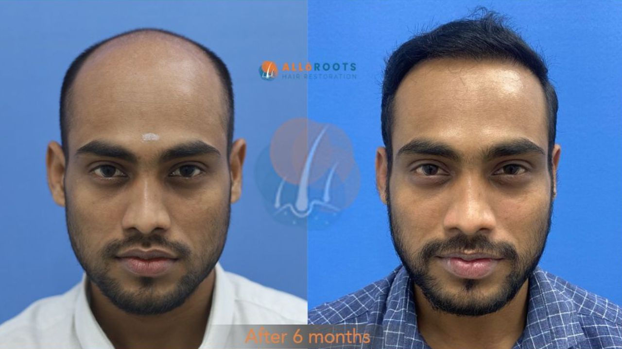 hair transplant bhubaneswar