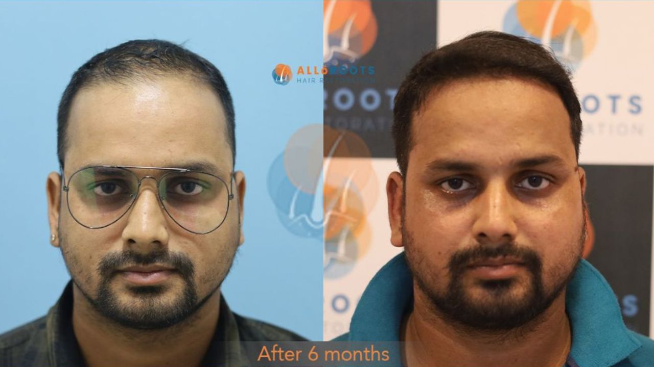 hair transplant bhubaneswar